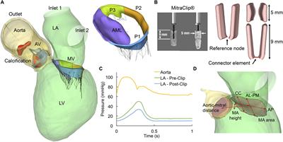 A Comprehensive Engineering Analysis of Left Heart Dynamics After MitraClip in a Functional Mitral Regurgitation Patient